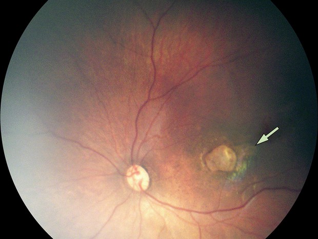 Exame de imagem mostra um caso de atrofia macular grave em bebê com microcefalia (Foto: The Lancet/Divulgação)